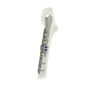 OsteoPoint™ Cerclage Bands & Plates 2