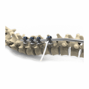 OsteoPoint™ Sternal Cerclage Band System