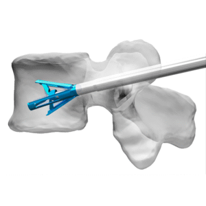 Synth™ Vertebral Compression Fracture (VCF) Solutions 2