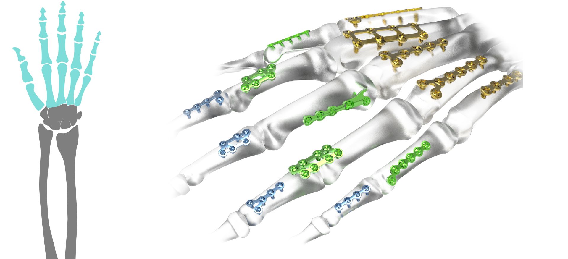 Combo 1,2 | 1,7 | 2,3mm