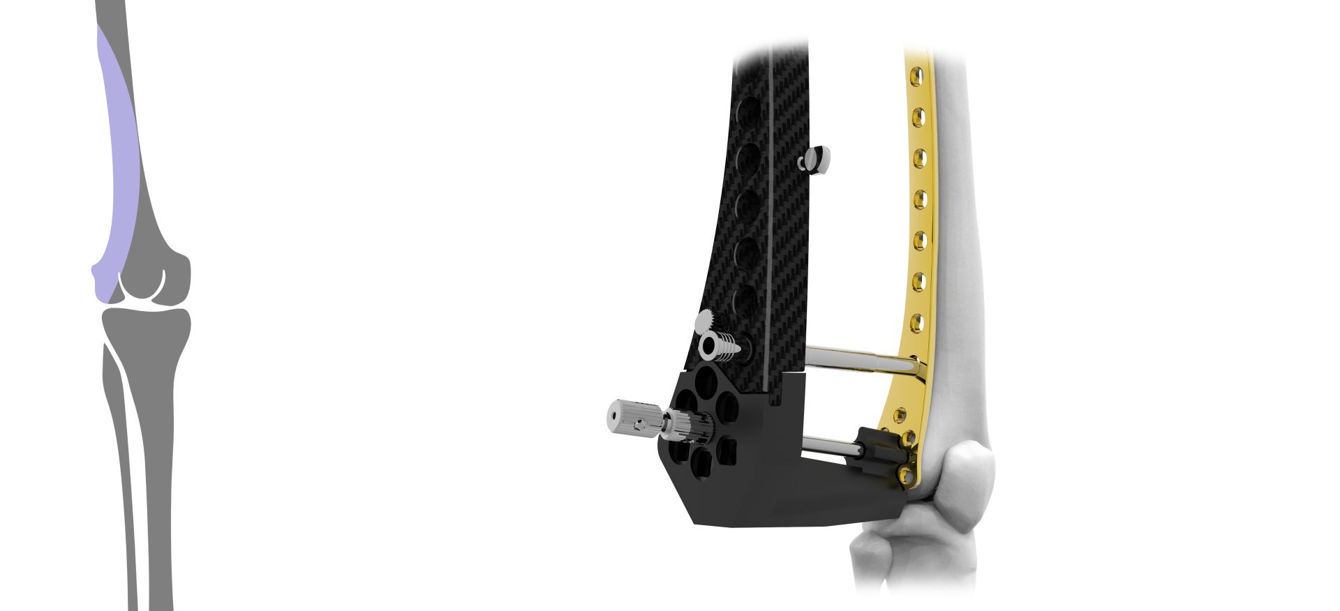 Femur Distal 4,5 / 5,0mm