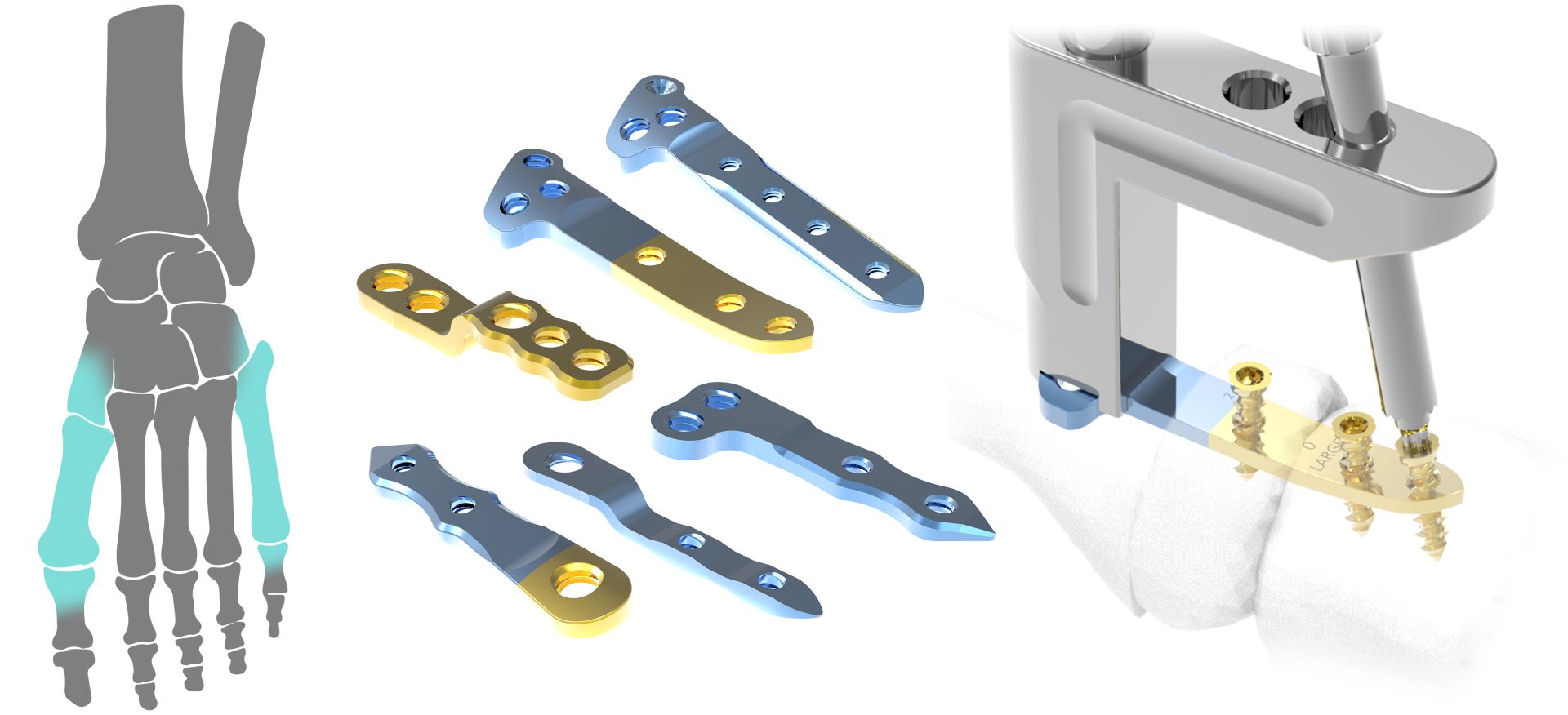 Hallux Valgus 2,7 / 3,5mm