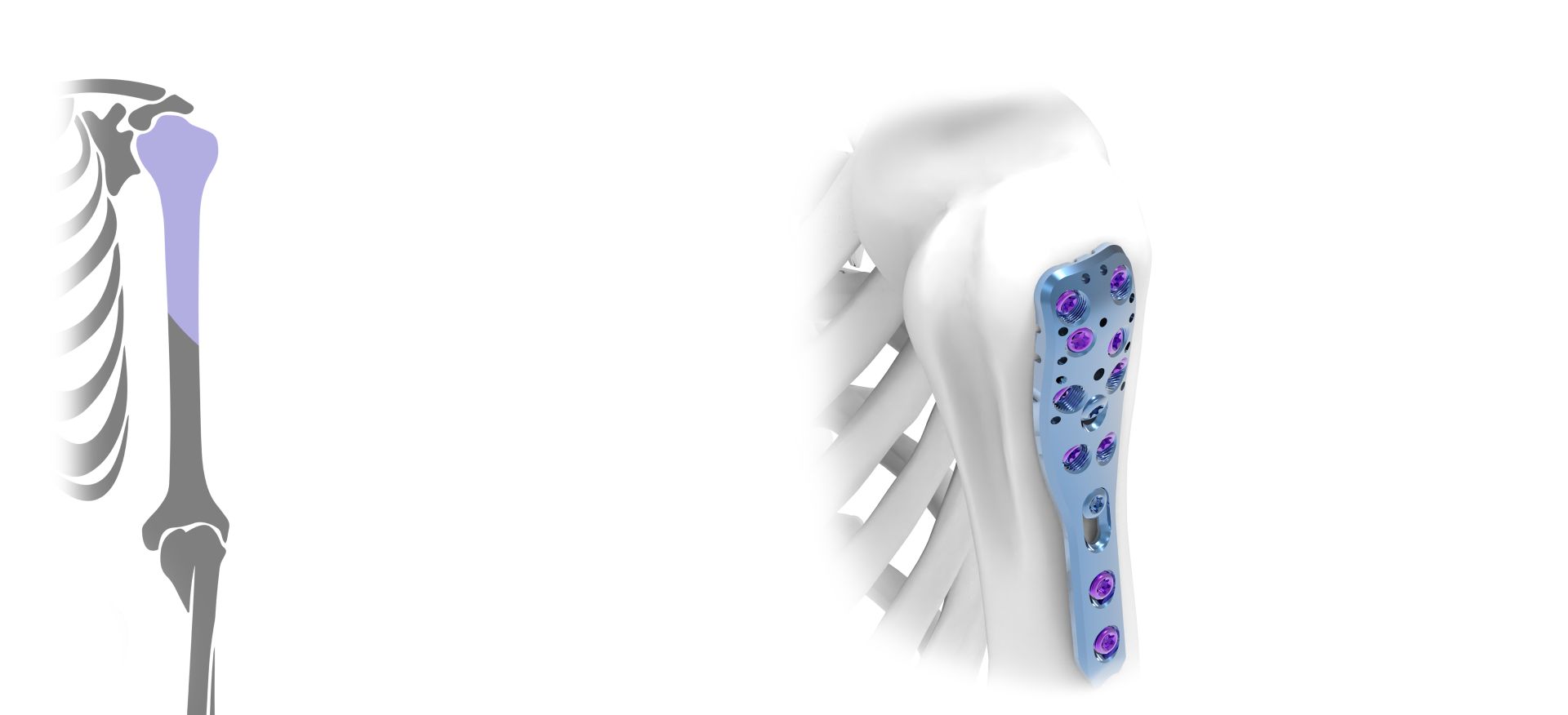 Humerus Proximal 3,5mm