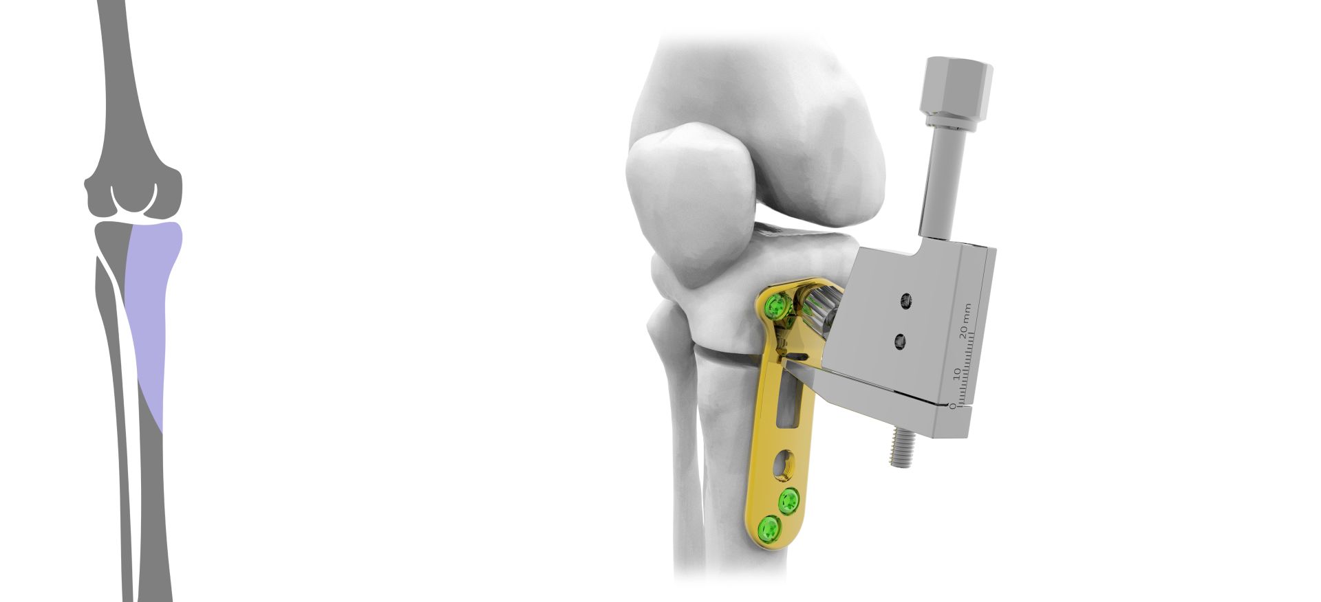 Tibial Osteotomy 4,5 / 5,0mm