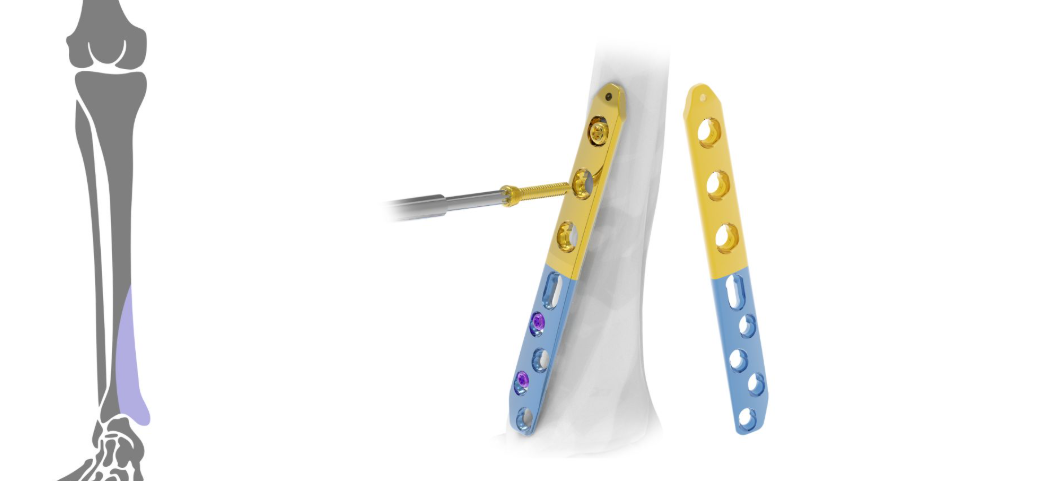 Metaphyseal 3,5 / 4,5mm